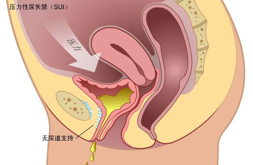 盆底康復(fù)之慢肌、快肌訓(xùn)練篇